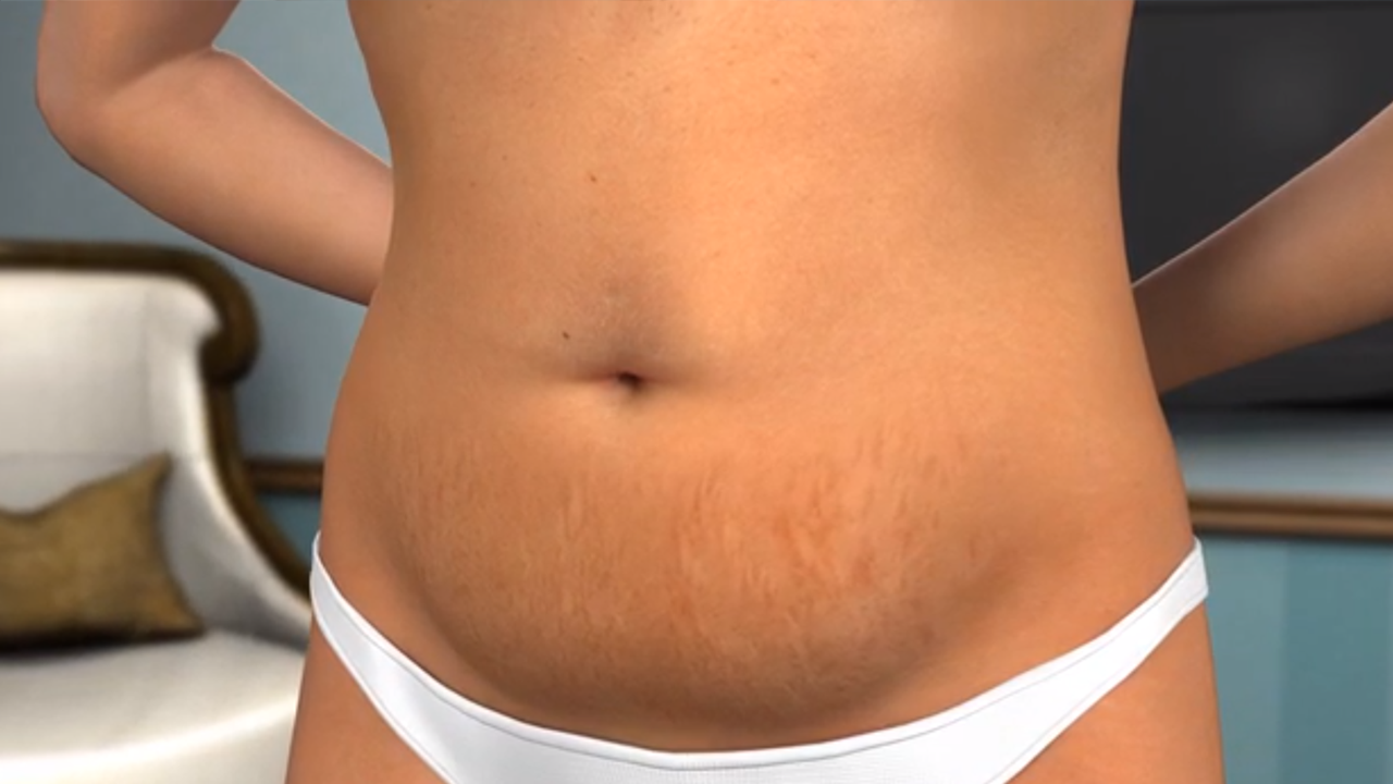 Abdominoplastia Combinada Outras Cirurgias Estéticas O Que Você